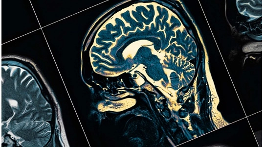 国际亨廷顿舞蹈症关爱日｜与爱共舞，JAX助力研究新进展！